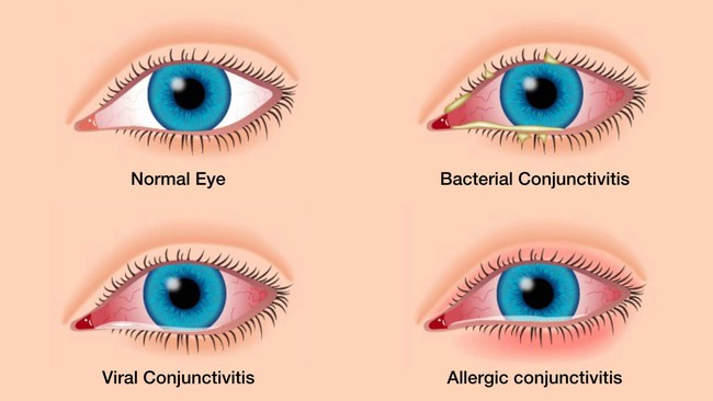 Sự khác nhau giữa mắt bình thường và đau mắt đỏ do vi khuẩn, virus và dj ứng theo thứ tự từ trái sang phải (Ảnh: Internet)