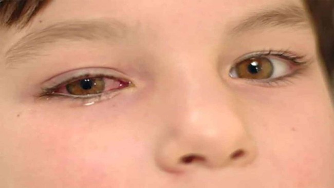Sự khác biệt giữa đau mắt đỏ và đau mắt hột bạn cần biết - Ảnh 1.