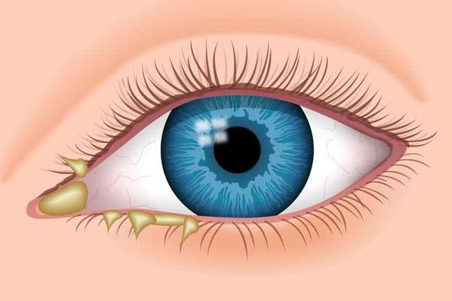 Các bước vệ sinh mắt khi bị đau mắt đỏ đúng chuẩn nhất - Ảnh 1.