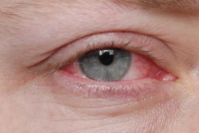Các bước vệ sinh mắt khi bị đau mắt đỏ đúng chuẩn nhất - Ảnh 2.