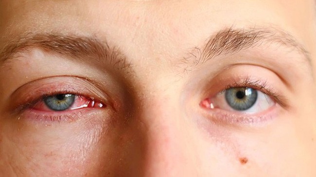 Sự khác biệt giữa đau mắt đỏ và đau mắt hột bạn cần biết - Ảnh 3.