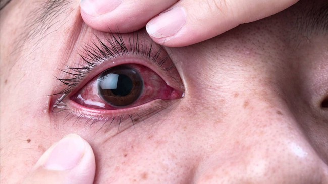 Sự khác biệt giữa đau mắt đỏ và đau mắt hột bạn cần biết - Ảnh 2.