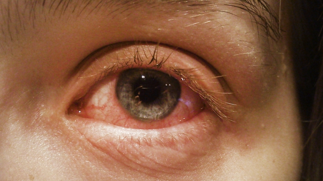 Tổng hợp từ A đến Z về các biến chứng đau mắt đỏ mà người bệnh có nguy cơ mắc phải - Ảnh 2.