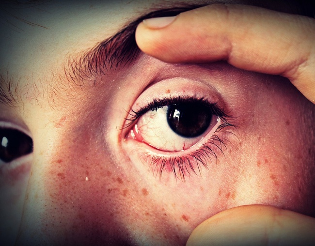 Tổng hợp từ A đến Z về các biến chứng đau mắt đỏ mà người bệnh có nguy cơ mắc phải - Ảnh 4.