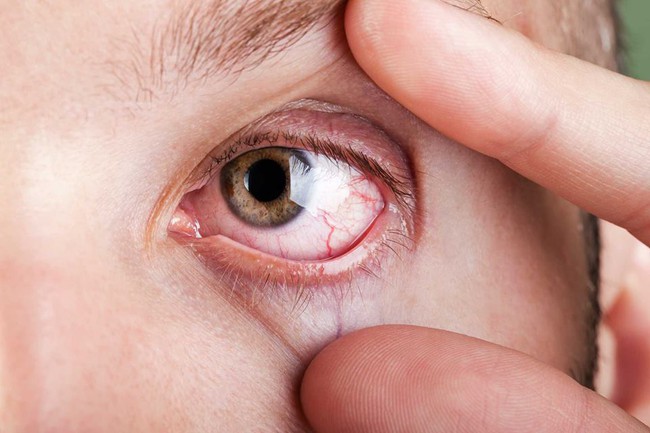 hiểu lầm về bệnh đau mắt đỏ chữa trị