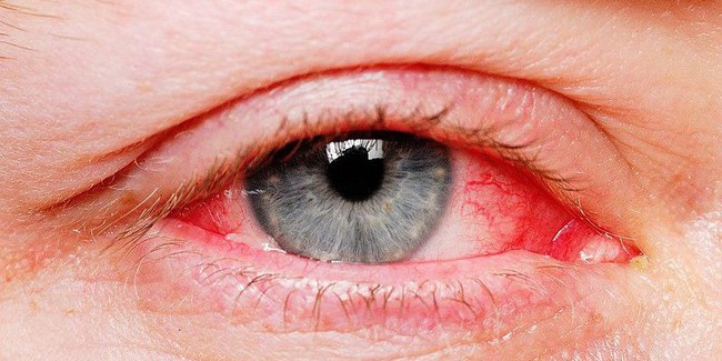 Điểm mặt 4 sai lầm khi điều trị đau mắt đỏ cần tránh - Ảnh 1.