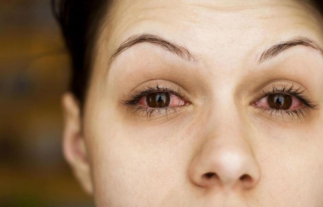 Những hình ảnh chi tiết nhất về triệu chứng của bệnh đau mắt đỏ - Ảnh 2.