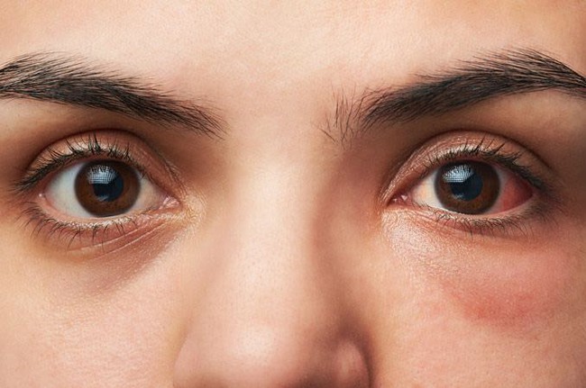 Sự khác biệt giữa đau mắt đỏ và viêm loét giác mạc không phải ai cũng biết - Ảnh 1.
