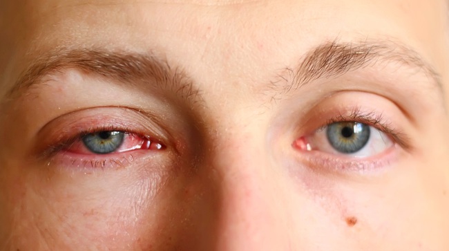 Phân biệt đau mắt đỏ và tăng nhãn áp để điều trị đúng cách - Ảnh 1.