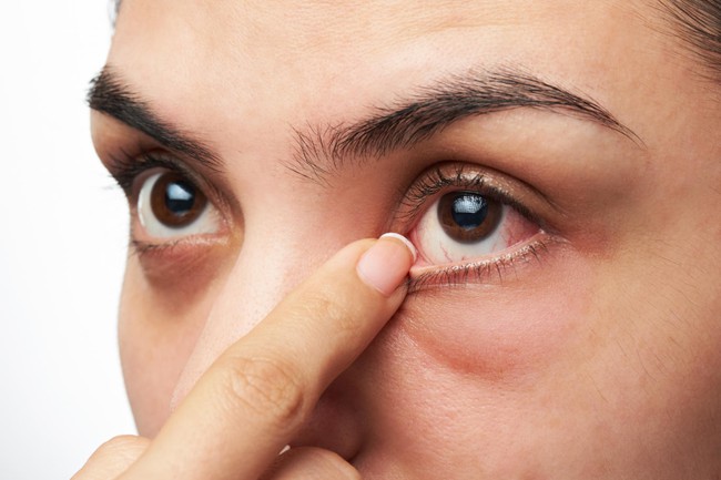 Đau mắt đỏ và viêm củng mạc: Những điều cần biết để điều trị đúng - Ảnh 3.