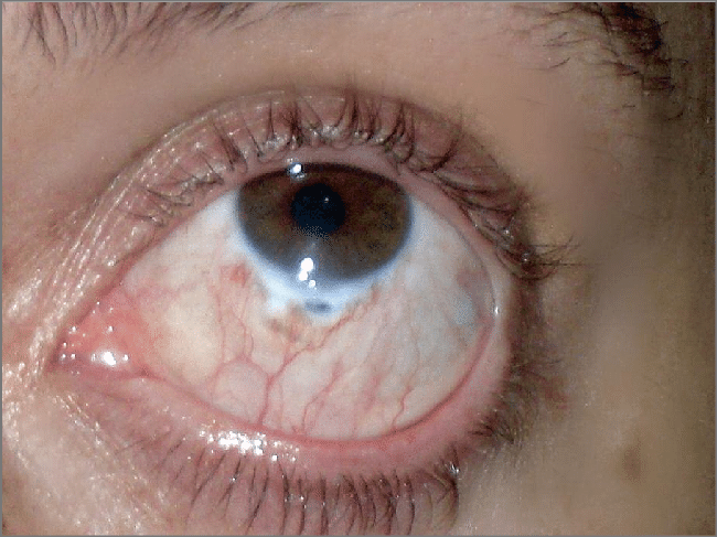 Điều trị biến chứng đau mắt đỏ: Tuyệt đối tuân thủ chỉ định bác sĩ và chủ động phòng ngừa - Ảnh 3.