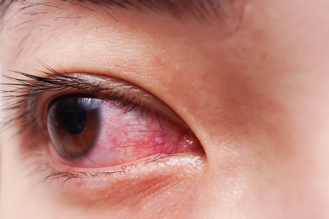 Điều trị biến chứng đau mắt đỏ: Tuyệt đối tuân thủ chỉ định bác sĩ và chủ động phòng ngừa - Ảnh 1.