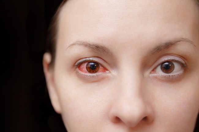 Những hình ảnh chi tiết nhất về triệu chứng của bệnh đau mắt đỏ - Ảnh 1.