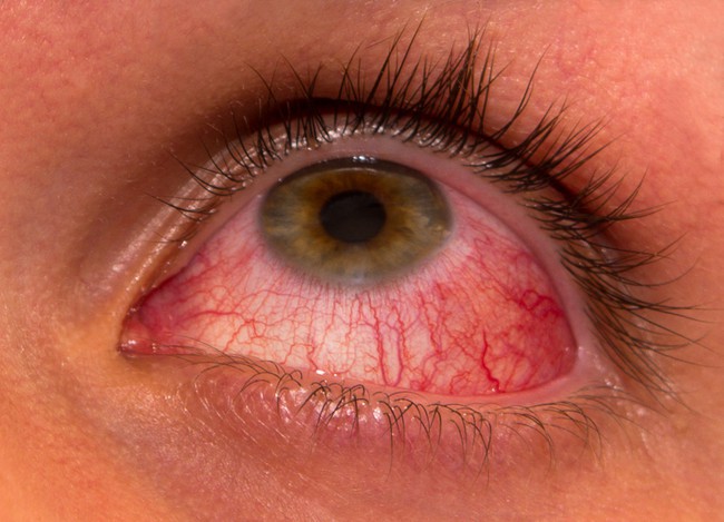 Những hình ảnh chi tiết nhất về triệu chứng của bệnh đau mắt đỏ - Ảnh 7.