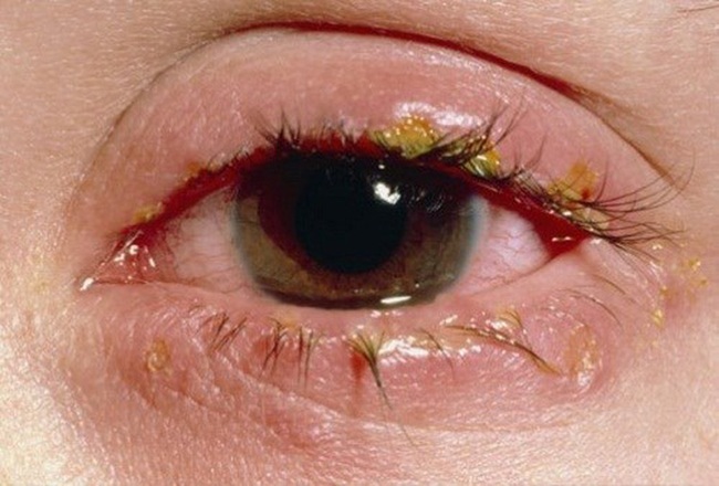 Tìm hiểu chung về bệnh đau mắt đỏ ở phụ nữ mang thai - Ảnh 3.