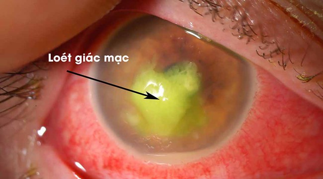 Những hình ảnh chi tiết nhất về triệu chứng của bệnh đau mắt đỏ - Ảnh 9.