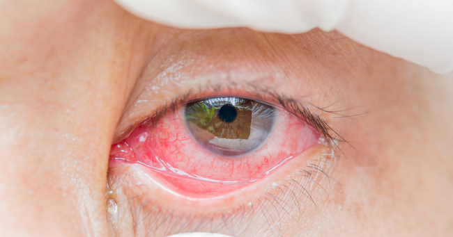 Phòng ngừa biến chứng đau mắt đỏ: Cẩn trọng trong việc tự điều trị và dùng thuốc! - Ảnh 3.