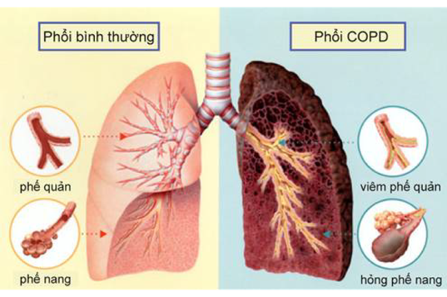 Các biện pháp làm giảm triệu chứng phổi tắc nghẽn mãn tính tại nhà - Ảnh 1.