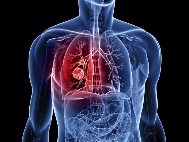 Có nhiều biến chứng nguy hiểm khi mắc bệnh phổi tắc nghẽn mãn tính giai đoạn 2 (Ảnh: Internet)