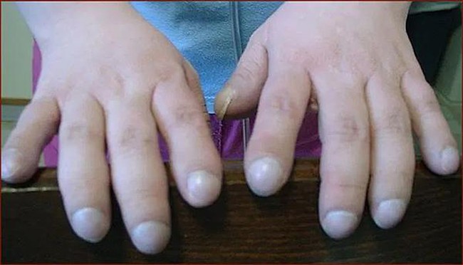 Ngón tay dùi trống ở trẻ mắc bệnh phổi tắc nghẽn mãn tính (Ảnh: Internet)
