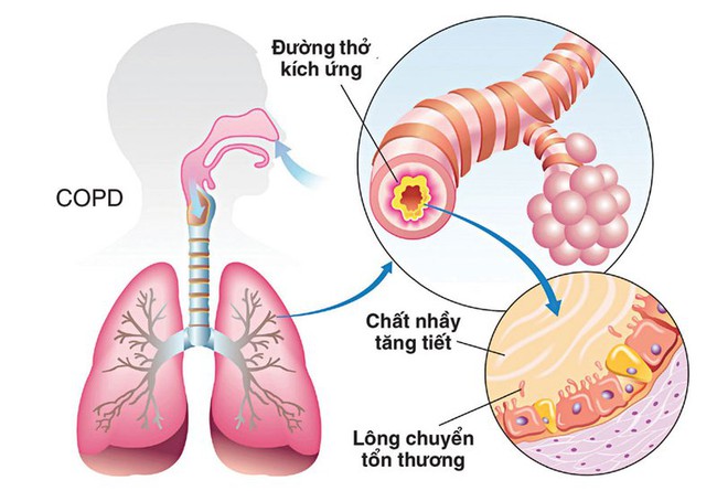 Tất tần tật các cách giảm khó thở khi bị COPD - Ảnh 1.
