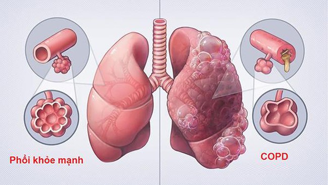 Tổng hợp các phương pháp làm sạch phổi khi bị COPD bệnh phổi tắc nghẽn mãn tính - Ảnh 1.
