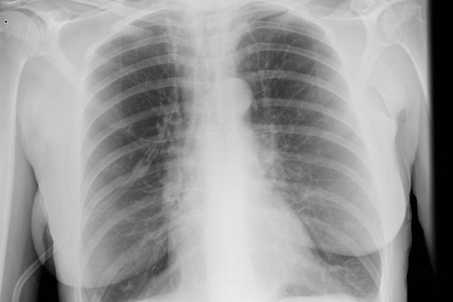 Chẩn đoán COPD được tiến hành như thế nào? - Ảnh 4.