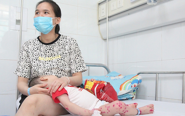 Trẻ em dưới 10 tuổi có nguy cơ mắc bệnh tay chân miệng cao nhất (Ảnh: Internet)