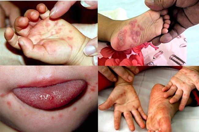 Tay chân miệng là một bệnh truyền nhiễm cấp tính do virus gây ra (Ảnh: Internet)
