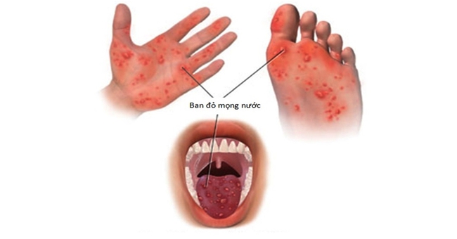 Cảnh giác với bệnh tay chân miệng và sốt xuất huyết để phòng tránh đúng cách - Ảnh 1.