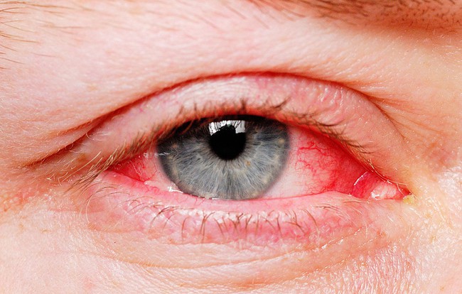 Tổng hợp các nguyên nhân gây đỏ mắt dẫn đến suy giảm thị lực - Ảnh 2.