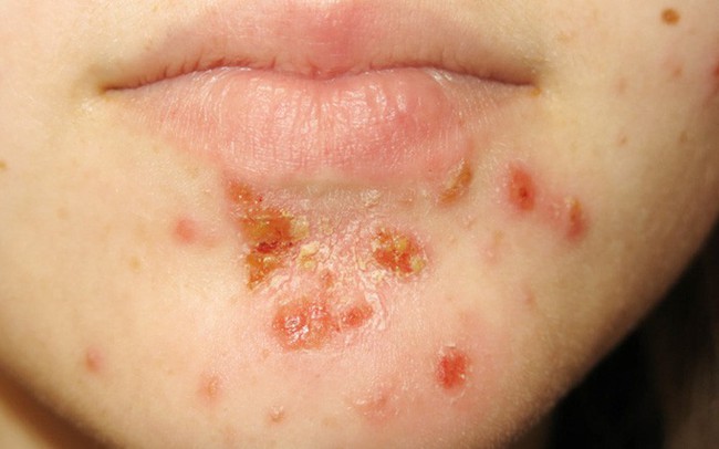 Điểm danh những bệnh về da mùa hanh khô thường gặp và cách xử lý - Ảnh 3.