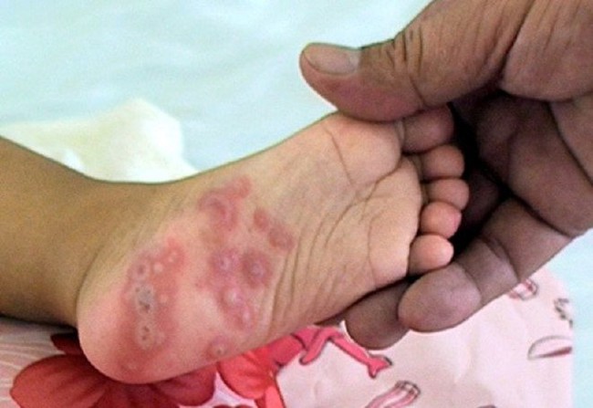 Bác sĩ cảnh báo căn bệnh nguy hiểm ở trẻ chỉ qua triệu chứng sốt, phát ban và vết loét ở miệng - Ảnh 3.