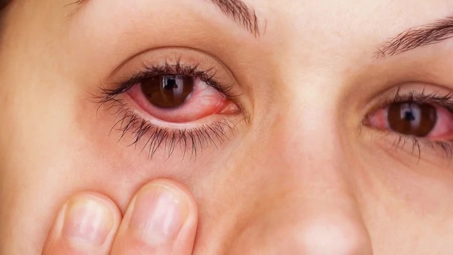 Tổng hợp các yếu tố làm tăng nguy cơ bị đau mắt đỏ - Ảnh 2.