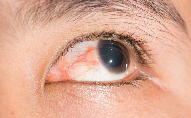 Đau mắt đỏ và viêm củng mạc: Những điều cần biết để điều trị đúng - Ảnh 4.