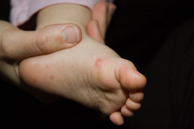 Chuyên gia y tế ‘mách’ cha mẹ cách tự kiểm tra bệnh tay chân miệng tại nhà cho trẻ - Ảnh 2.