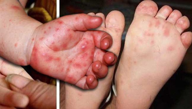 Tay chân miệng là một bệnh truyền nhiễm khá phổ biến ở trẻ em (Ảnh: Internet)