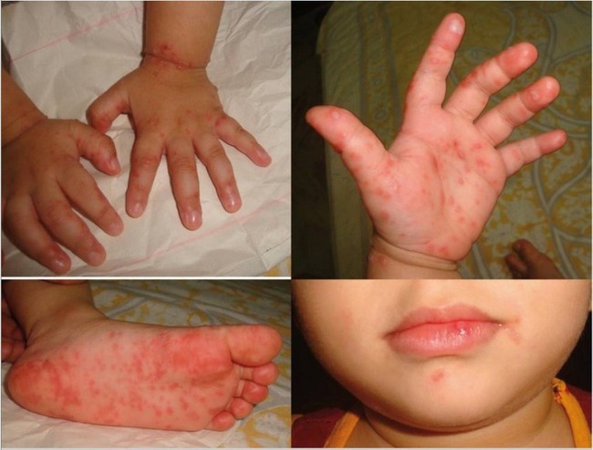 Dấu hiệu toàn phát bệnh tay chân miệng ở trẻ em - Ảnh 3.
