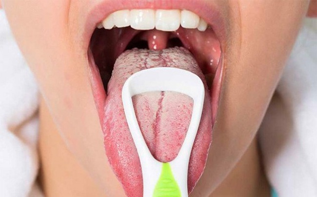 Lưỡi trắng là gì? Những điều cần biết về lưỡi trắng - Ảnh 2.