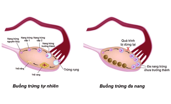 Những yếu tố dễ khiến phụ nữ bị vô sinh - Ảnh 3.