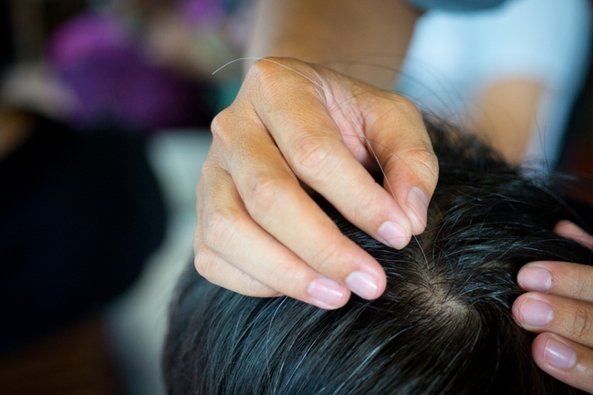 Nghiên cứu khoa học: Bứt tóc, nhổ lông mi là dấu hiệu bệnh tâm thần