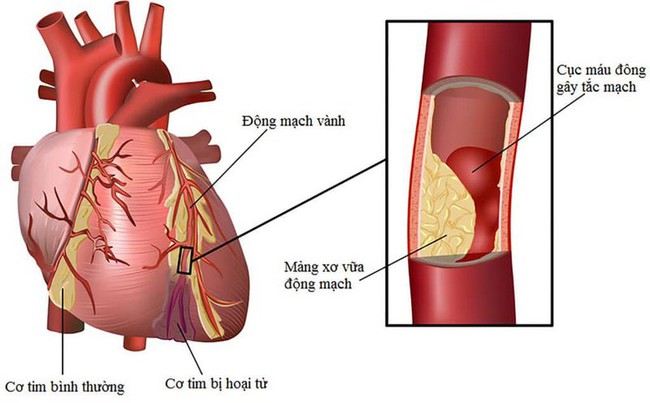 Bệnh thiếu máu cơ tim là gì? Dấu hiệu, nguyên nhân và cách điều trị - Ảnh 3.
