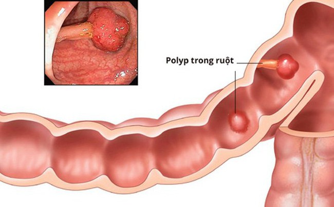 Bệnh polyp đại trực tràng là gì? Những điều cần biết về polyp đại trực tràng - Ảnh 2.