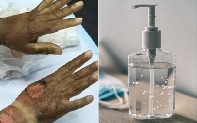 Sử dụng nước rửa tay khô để phòng tránh dịch COVID-19 có thật sự an toàn, khi nào thì gây hại cho sức khỏe - Ảnh 2.