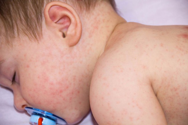 Nhận biết và phân biệt sớm sốt xuất huyết với sốt phát ban - Ảnh 2.