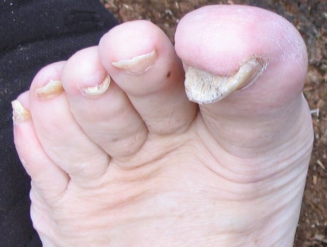 Các dạng viêm nhiễm da ở chân trong mùa mưa và cách phòng tránh - Ảnh 2.