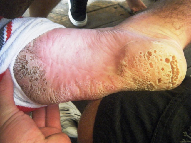 Các dạng viêm nhiễm da ở chân trong mùa mưa và cách phòng tránh - Ảnh 3.