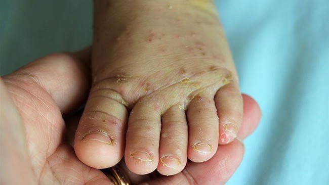 Các dạng viêm nhiễm da ở chân trong mùa mưa và cách phòng tránh - Ảnh 4.