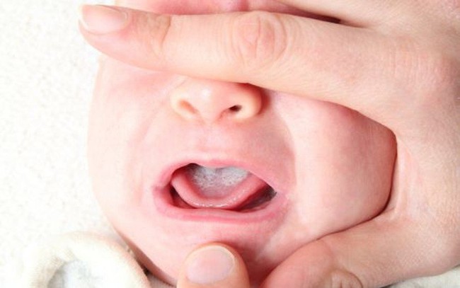 Tưa lưỡi là gì? Cách đánh tưa lưỡi cho trẻ sơ sinh như thế nào? - Ảnh 2.
