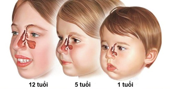 Nhận biết các dấu hiệu viêm xoang ở trẻ em - Ảnh 2.